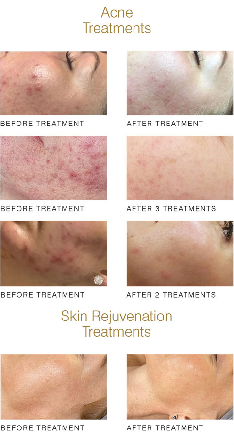 Black Diamond Laser Treatment Before and after