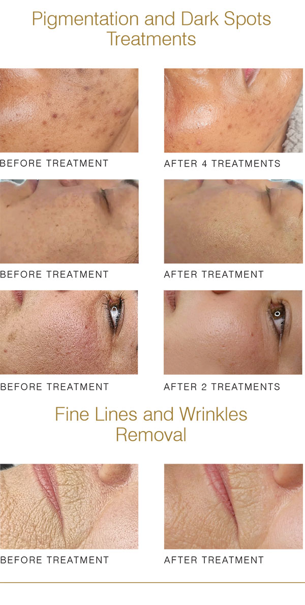 Black Diamond Laser Treatment Before and after