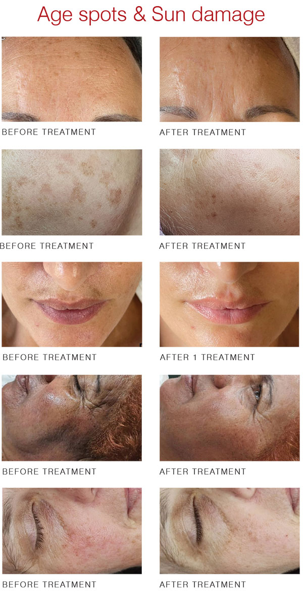 Clear Diamond Laser Treatment Before and after